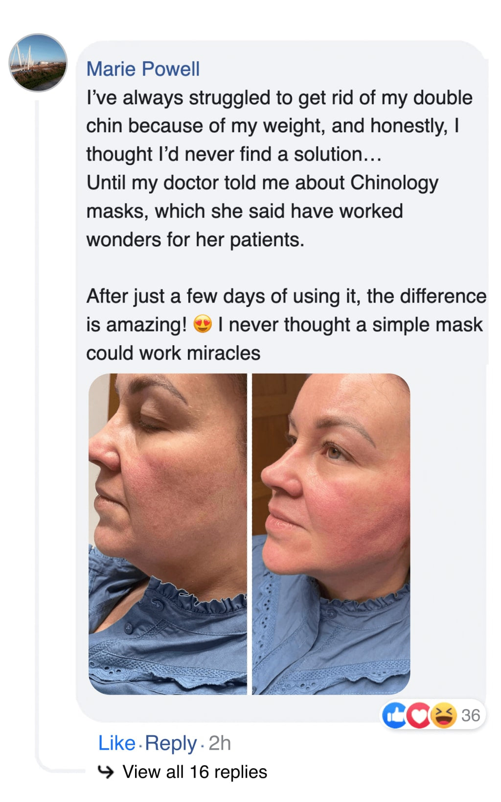 Double chin lifting mask by Riverwoods