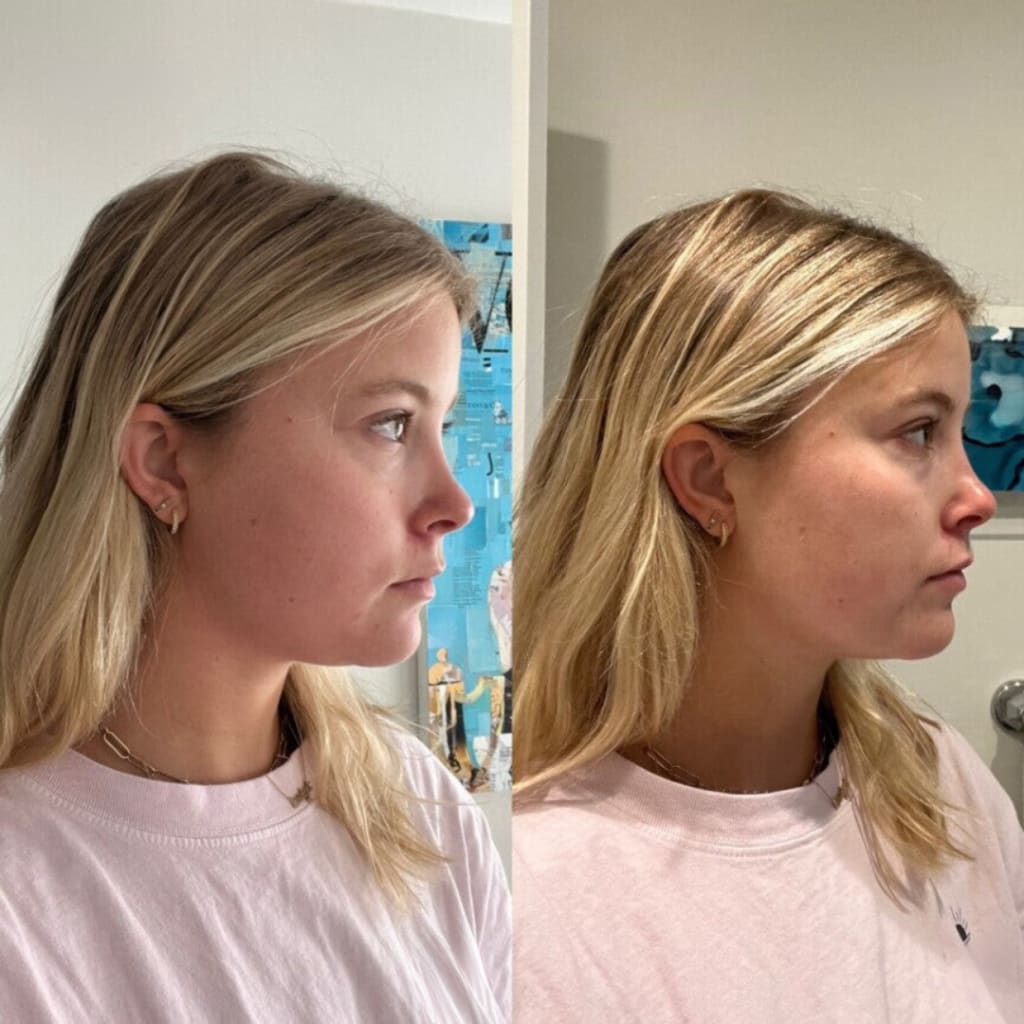 Double chin lifting mask by Riverwoods