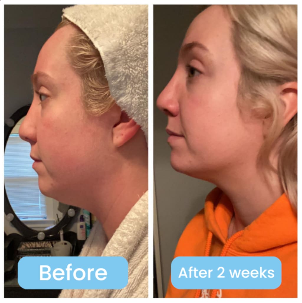 Double chin lifting mask by Riverwoods