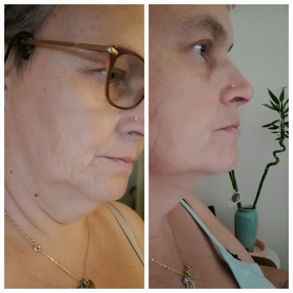 Double chin lifting mask by Riverwoods