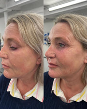 Double chin lifting mask by Riverwoods